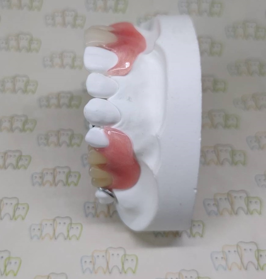 ノンクラスプデンチャー2